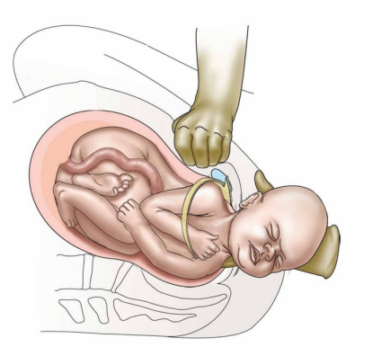 diagram of shoulder dystocia