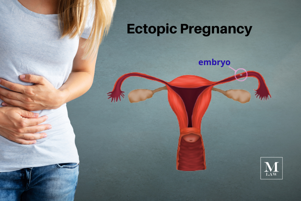 diagram of ectopic pregnancy