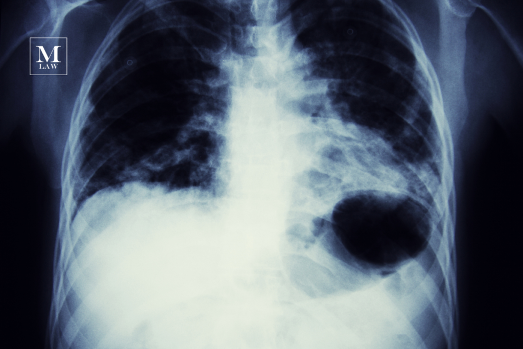 x-ray showing tumor in lung