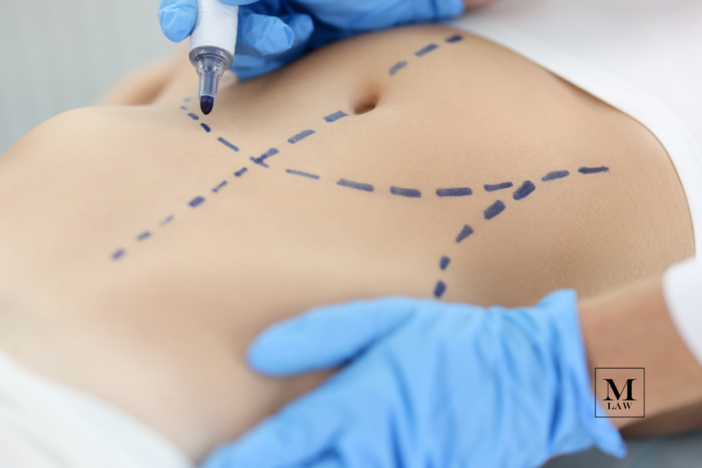 surgeon marking incisions to ensure no surgical errors