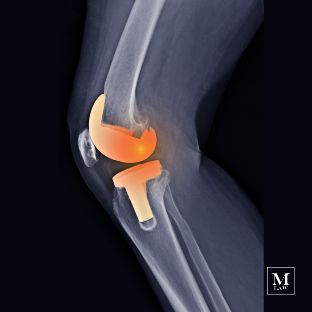 x-ray of a knee replacement