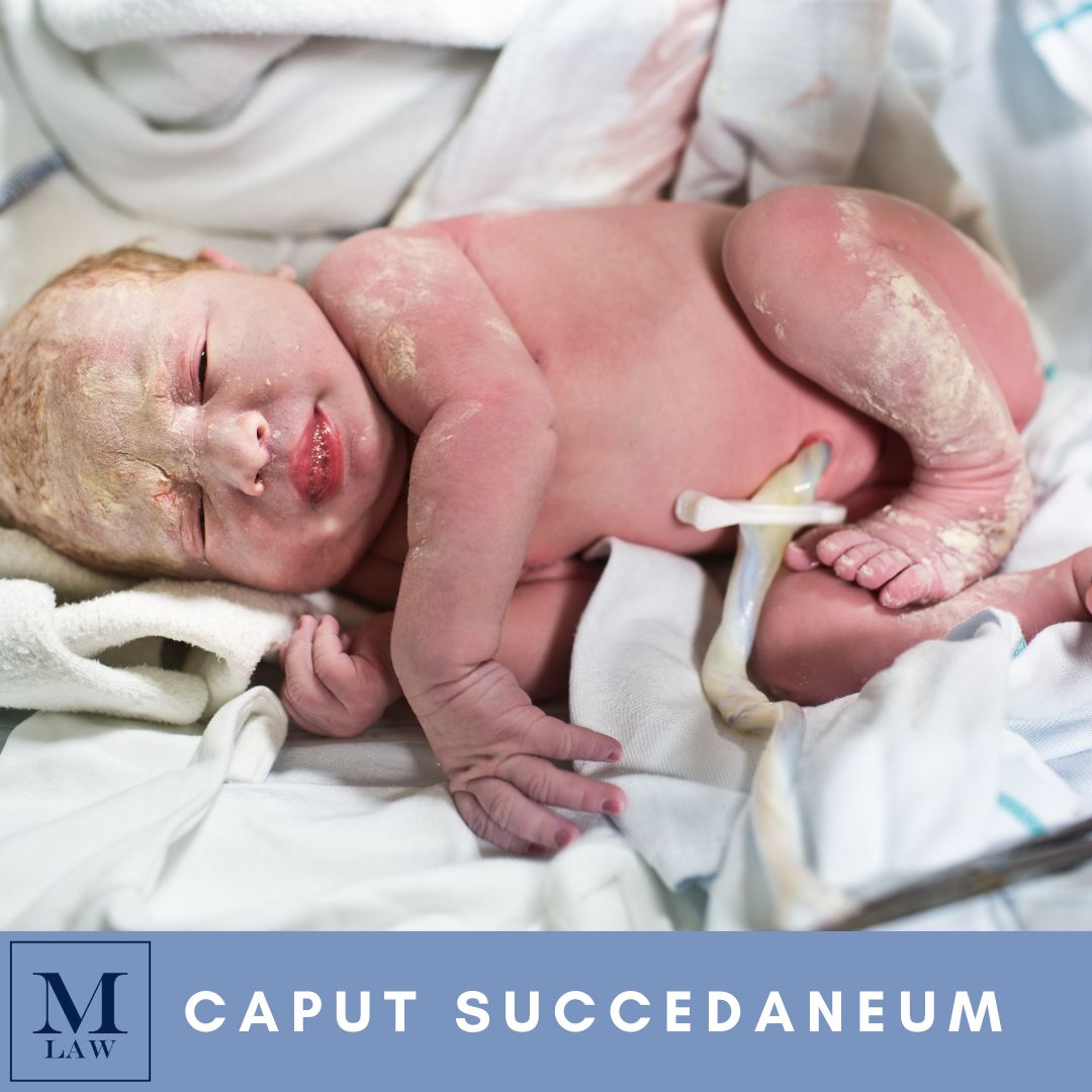 newborn with caput succedaneum