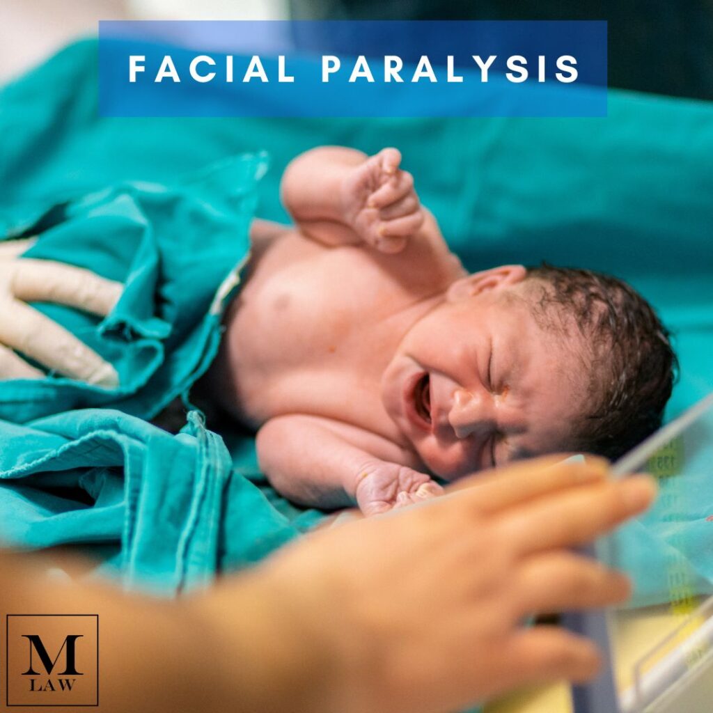 newborn suffering from congenital facial paralysis
